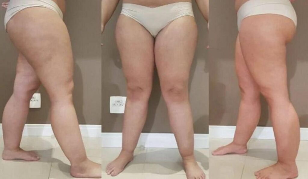 Lipedema
